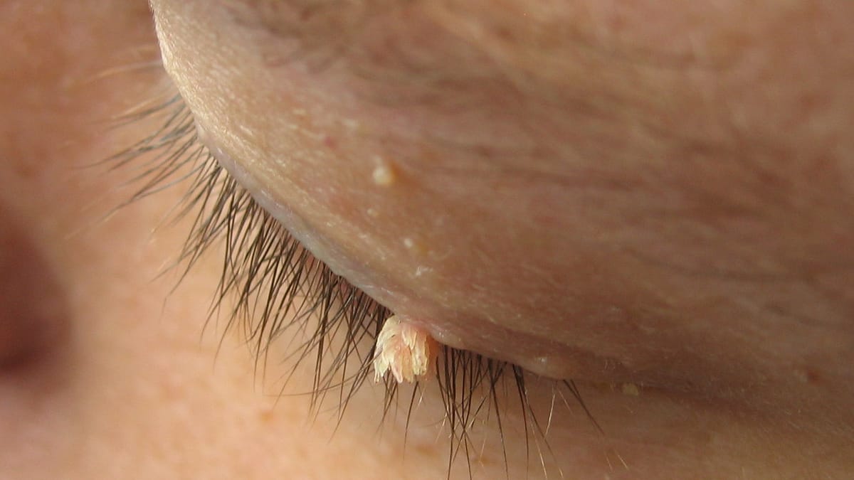 Wart on eyelid
